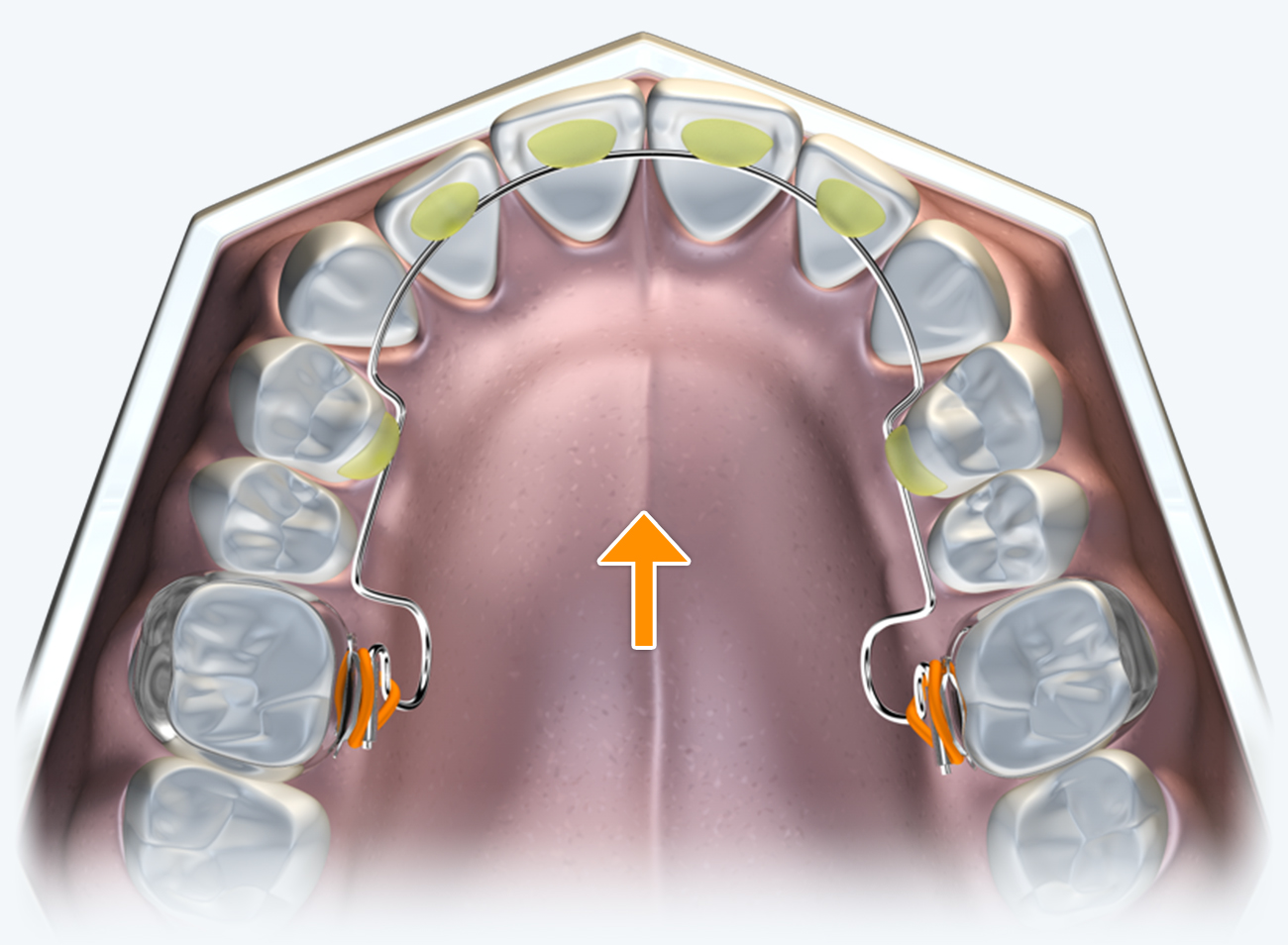 No palatal component