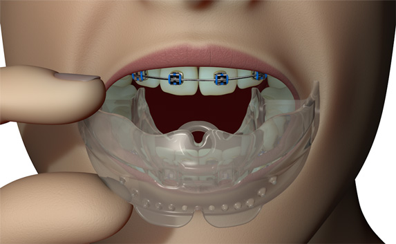 myobrace　Medium The Myobrace® System