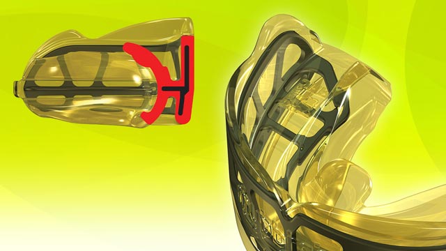 Myobrace for Interceptive Class III