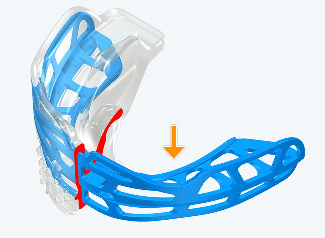 Modified Dynamicore™ with (Frankel Cage)