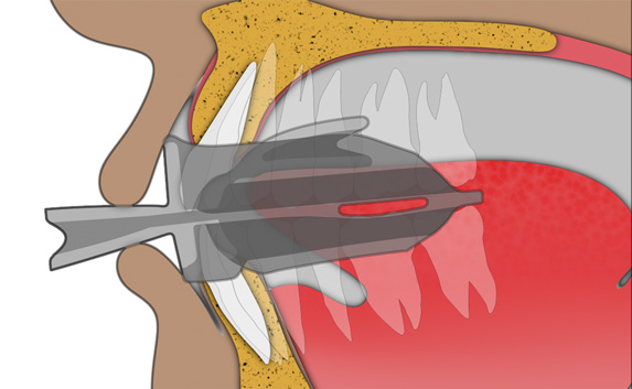 Jaw Exercise Step 2