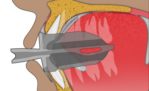 Tongue Exercise: Step 2