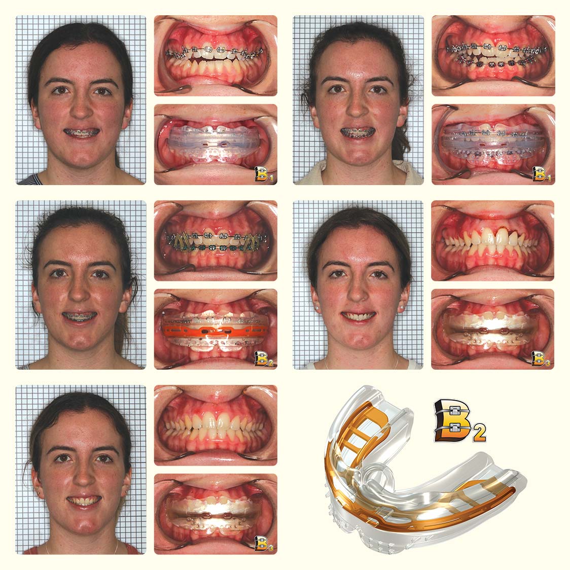 Correction of Overbite