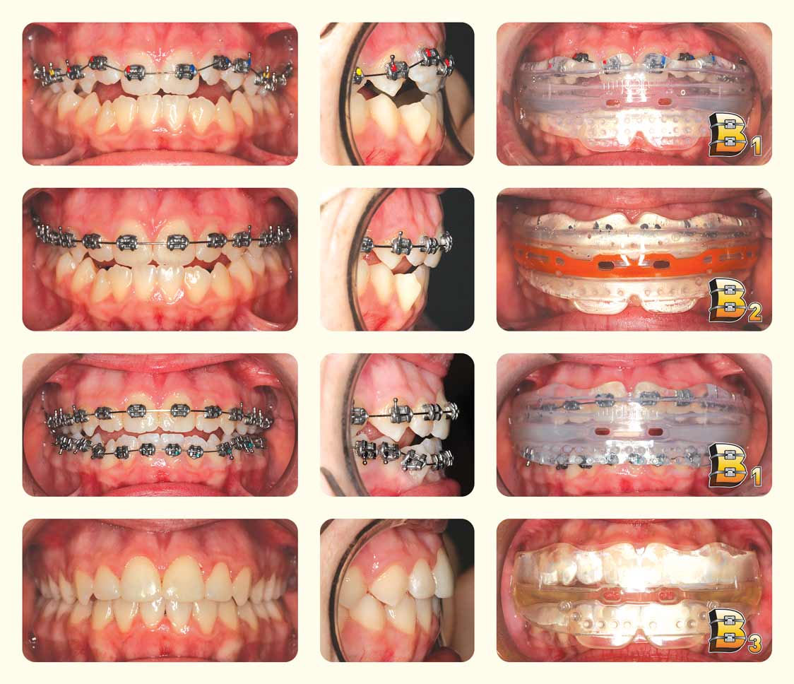 Correction of Overbite